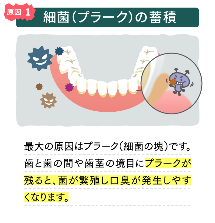 原因1 細菌（プラーク）の蓄積