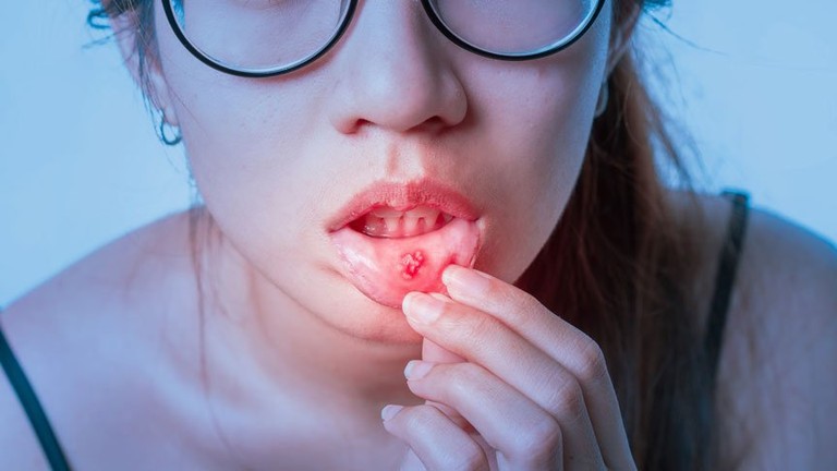 口内炎の原因