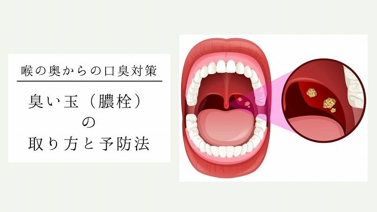 臭い玉（膿栓）の取り方｜口臭の原因となる、喉の奥の白い塊の正体とは？