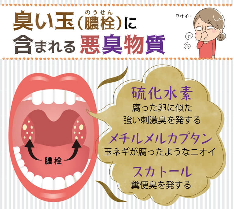 喉の奥にたまる「臭い玉（膿栓）」と口臭の関係