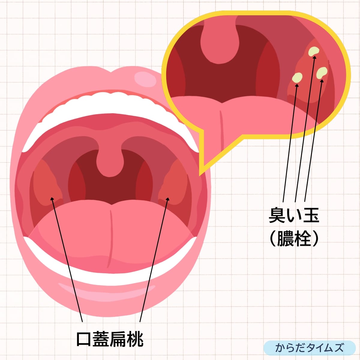 喉の奥にある白い塊は膿栓という
